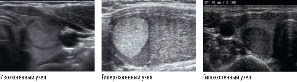 Гиперэхогенным округлым образованием. Эхогенные узлы щитовидной железы УЗИ. Гиперэхогенные узлы щитовидной железы что это такое. Гиперэхогенный узел в щитовидной железе УЗИ. Гипоэхогенный узел щитовидной железы что это такое.